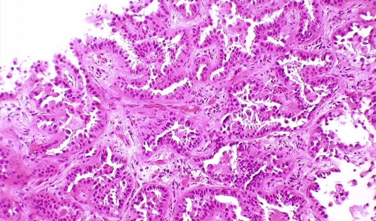 Biopsija pokazuje invazivni oblik raka pluća. Izvor: Yale Rosen putem flickra/CC BY-SA 2.0