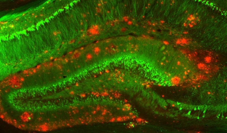 Regija mozga povezana s pamćenjem u mišjem modelu Alzheimerove bolesti. Zeleni dijelovi su neuroni, dok su crveni dijelovi amiloidni beta klasteri. Izvor: Nacionalni centar za unapređenje translacijske medicine putem Flickr/CC BY 2.0