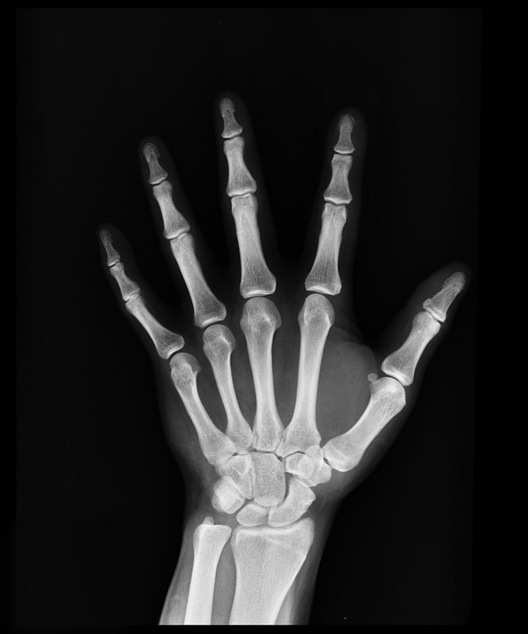 Rendgenski snimak ruke. Izvor: www.pexels.com